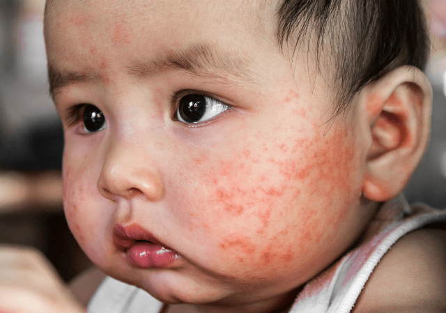 eczema-o-tre Flucort-N®