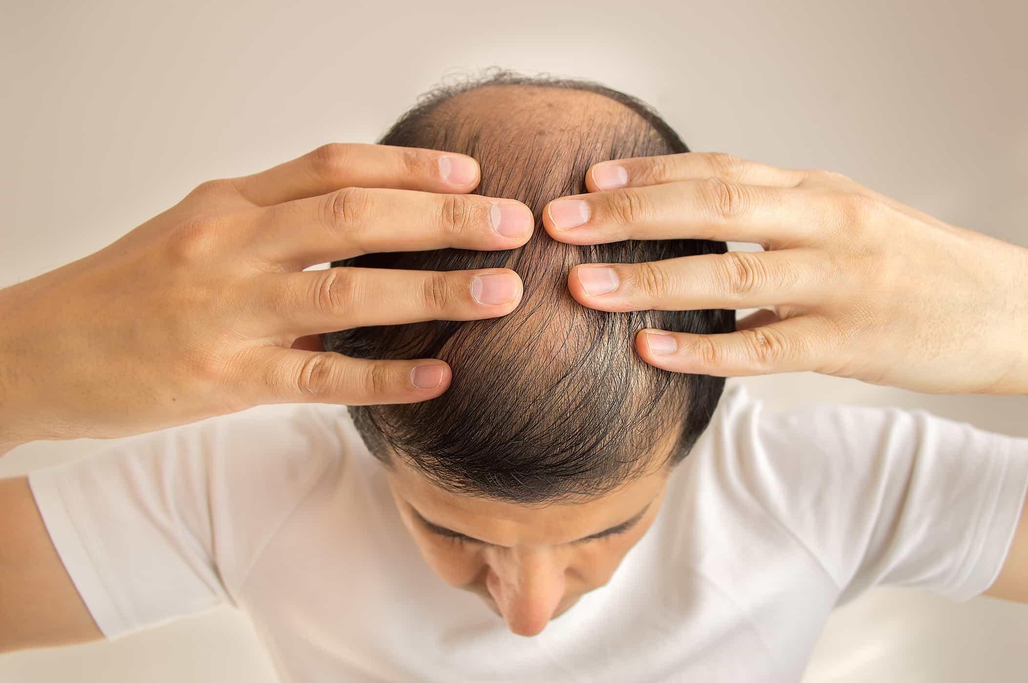 501619924 Minoxidil Opodex®