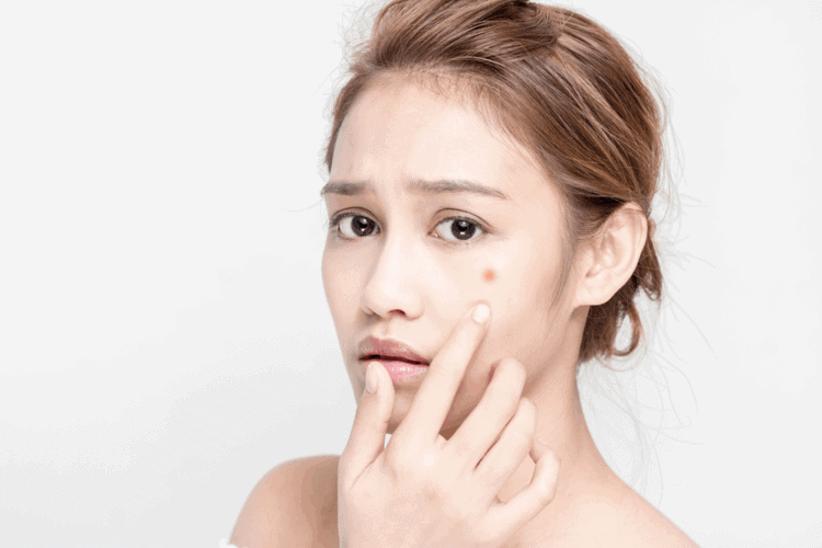 mat-na-tinh-trung-ngan-chan-mun-trung-ca-e1556089467567 không dùng trangala cho mụn trứng cá