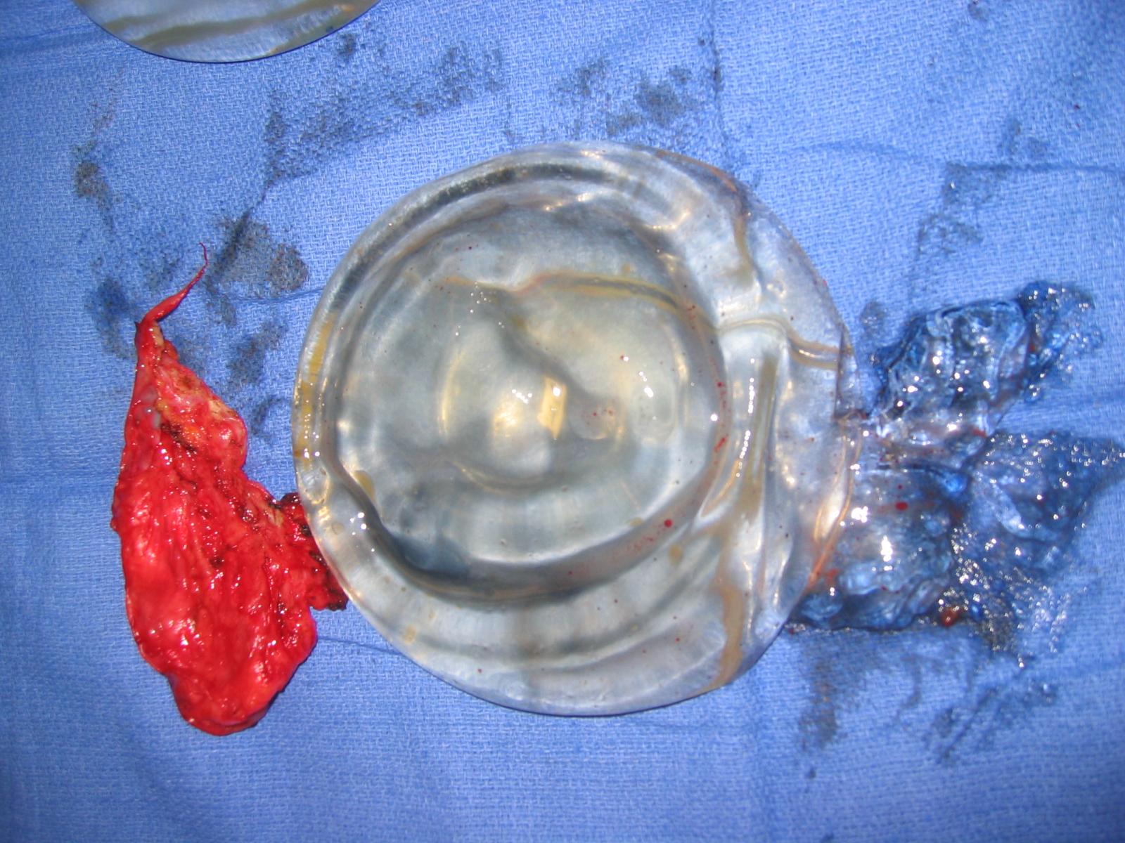 ruptured_implant Xylocaine® Jelly