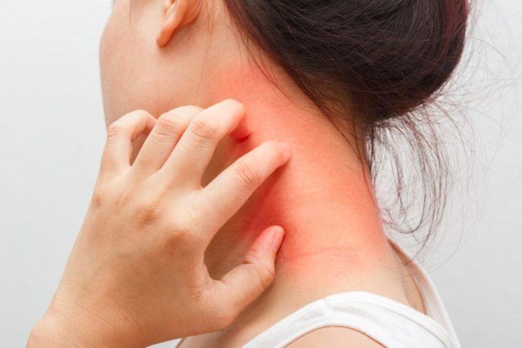 viem-da-co-dia_1-e1545986943400 viêm da cơ địa